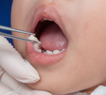 Deciduous Tooth Extraction